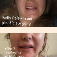 acupuncture palsy